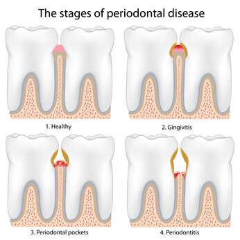 Periodontal Therapy Westend Dentist Dentist Edmonton